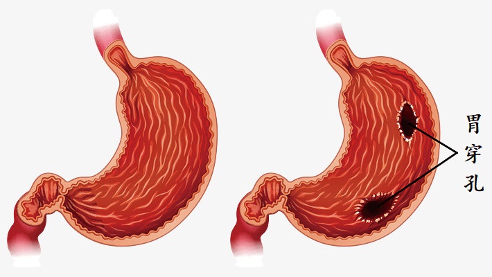 你知道胃穿孔有哪些类型吗