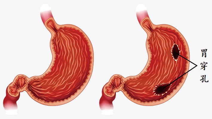 你知道胃穿孔有哪些类型吗?